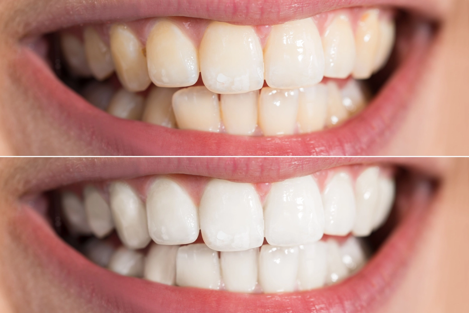 Before and after of cosmetic dentistry