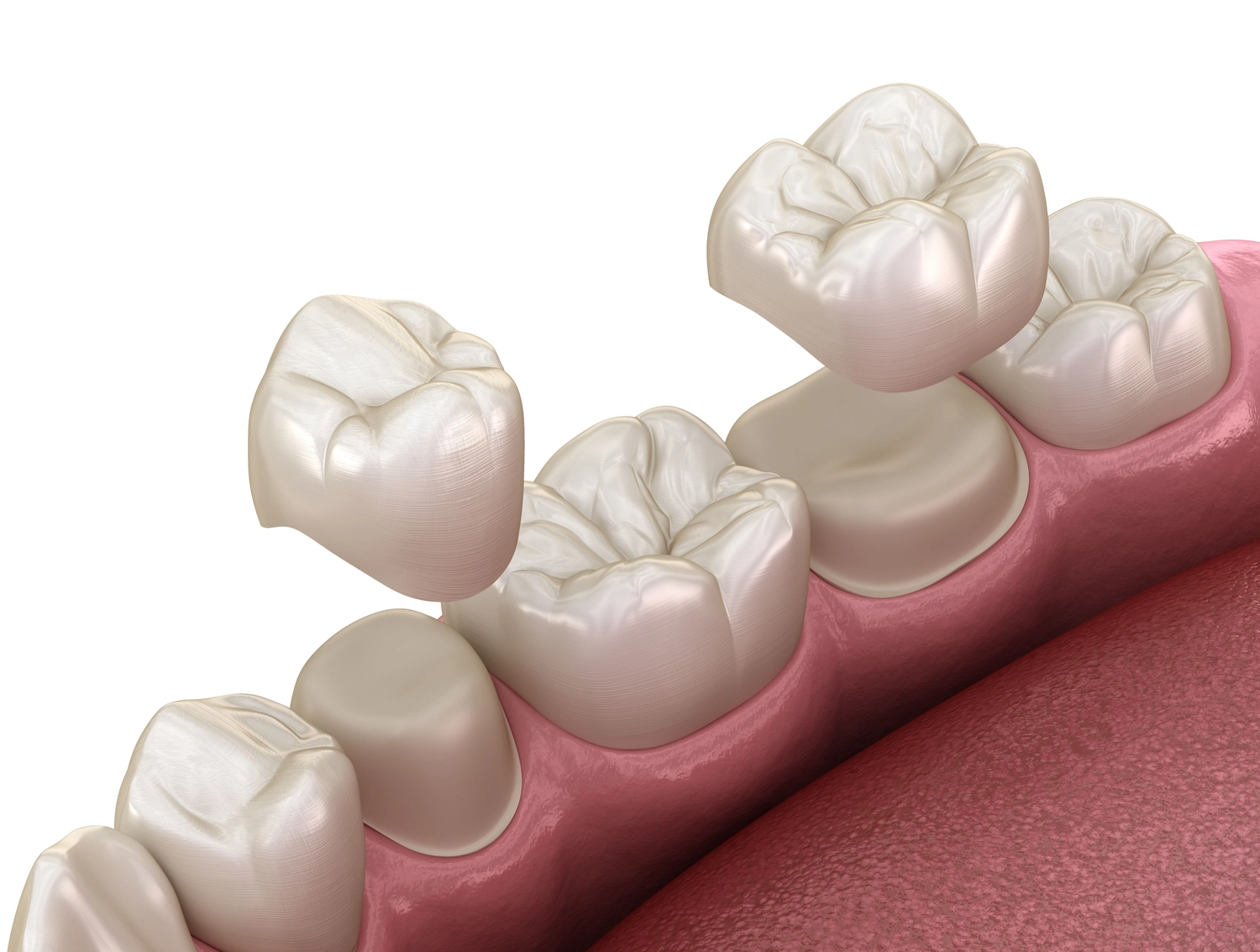 Dental Crown model