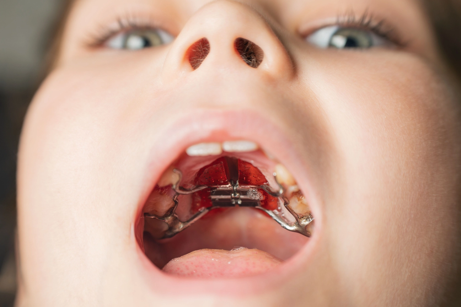 Child with orthodontic expanders