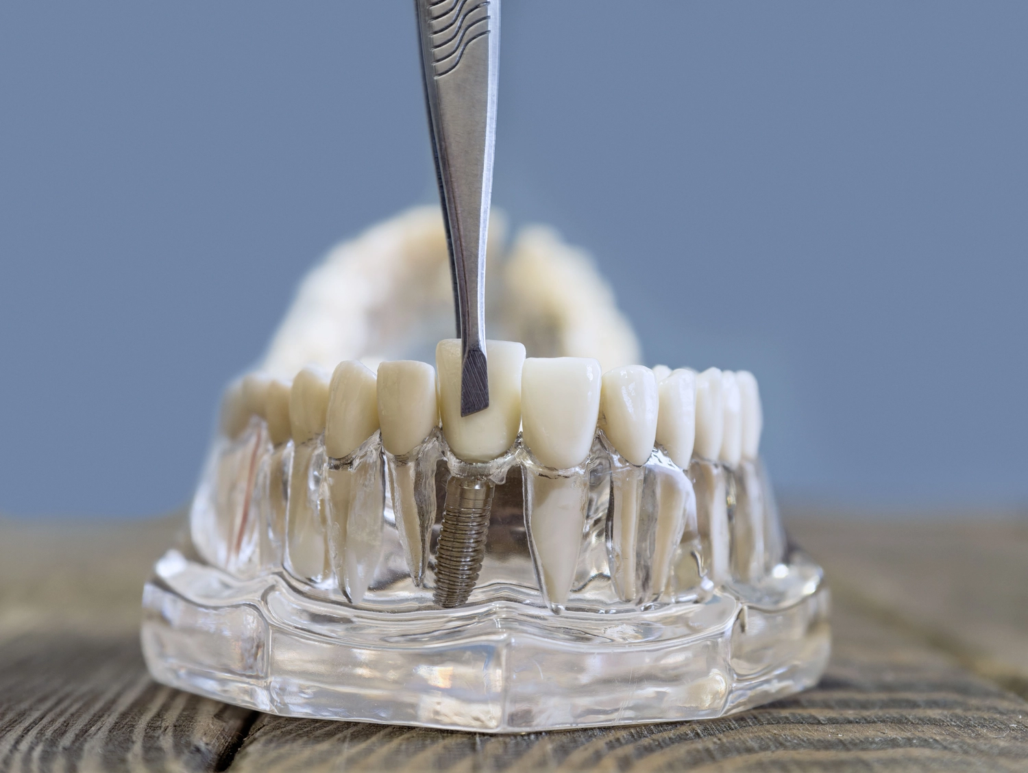 Full mouth model with dental implant