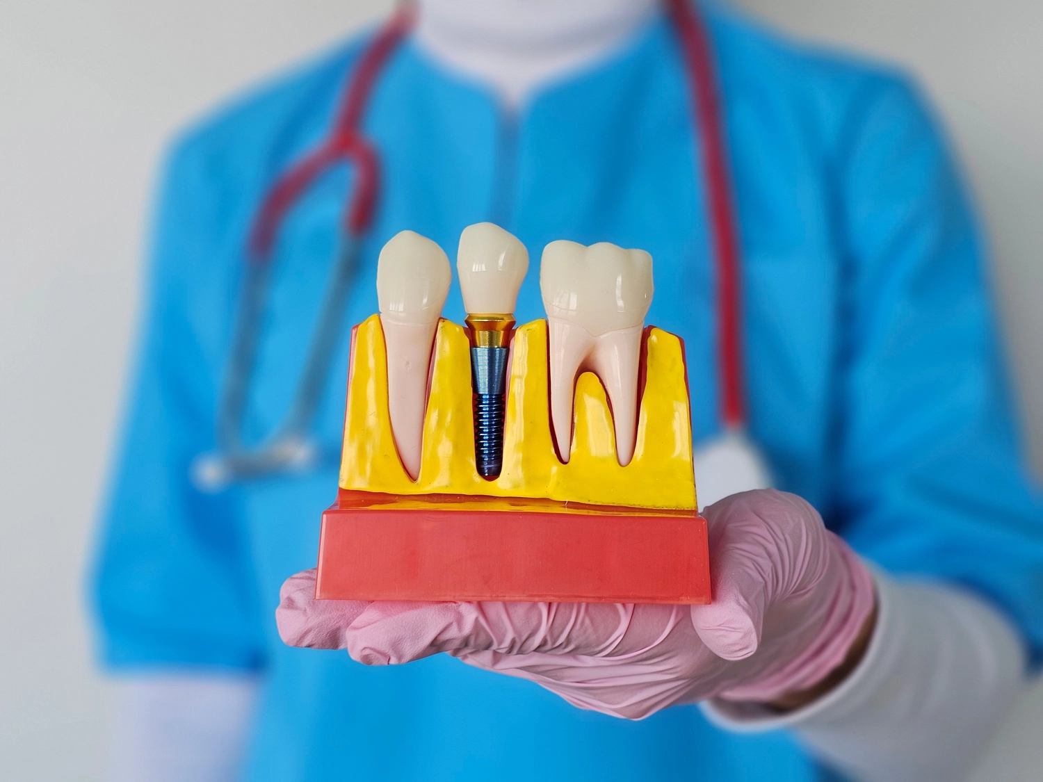 Dental Implant Model