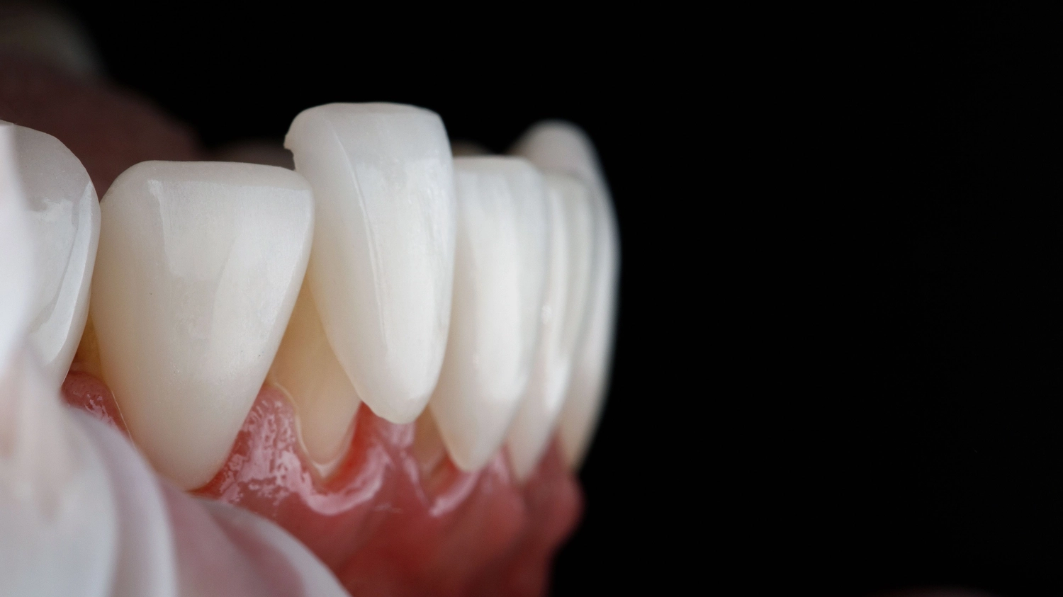 Dental Veneer example